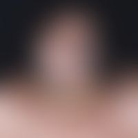 Alopecia androgenetica in a female patient: Stage III: Pronounced hair thinning in the frontopari...