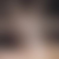 Alopecia androgenetica in the woman; distinct hair thinning in the parietal region in a 28-year-o...