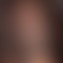 Alopecia androgenetica bei der Frau. Klassische, initiale, androgenetische Alopezie vom female pa...
