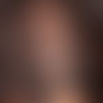 Alopecia androgenetica bei der Frau. Klassische, initiale, androgenetische Alopezie vom female pa...
