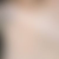 Alopecia areata: Sharply defined, roundish, hairless area in the beard area.

