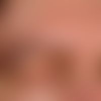 Alopecia areata:&nbsp;Seit 6 Monaten persistierende, fokale Alopezie der rechten Augenbraue bei e...