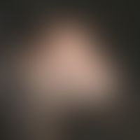 Alopecia areata: Beginningnew hair growth of a hairless area in an 8-year-old girl which has exis...