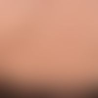 Alopecia areata: Still relapsing-active alopecia areata: Marginal area, cadaverized hair and excl...