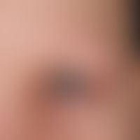 Alopecia areata: Kompletter Verlust von Augenbrauen und Wimpern.
