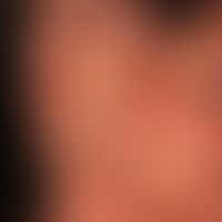 Alopecia areata: Typischer klinischer Befund einer Alopecia areata bei gleichzeitig bestehender z...