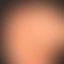 Alopecia areata diffusa, no circumscribed alopecia foci; suddenly occurring diffuse effluvium.
