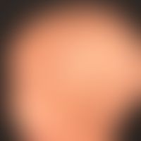 Alopecia areata diffusa, no circumscribed alopecia foci; suddenly occurring diffuse effluvium.
