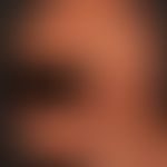 Alopecia areata totalis, complete hair loss on the capillitium and eyebrows except for a few shor...