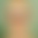 Alopecia areata universalis. loss of head and beard hairs, eyebrows and eyelashes