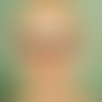 Alopecia areata universalis. loss of head and beard hairs, eyebrows and eyelashes