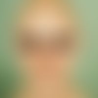 Alopecia areata universalis. loss of head and beard hairs, eyebrows and eyelashes