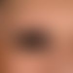 Alopecia areata universalis: Complete loss of body hair including eyebrows in a 69-year-old femal...