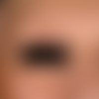 Alopecia areata universalis: Complete loss of body hair including eyebrows in a 69-year-old femal...