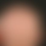 Alopecia areata universalis: Complete loss of head hair in a 69-year-old female patient after tre...