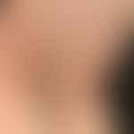 Alopecia areata universalis: Complete loss of axillary hair in a 69-year-old female patient after...
