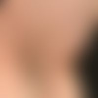 Alopecia areata universalis. Vollständiger Verlust der Axillenbehaarung bei einer 69-jährigen Pat...