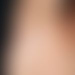 Alopecia areata universalis: Acute, complete loss of axillary hair in a 23-year-old patient with ...
