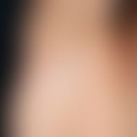 Alopecia areata universalis. Akut aufgetretener, vollständiger Verlust der Axillenbehaarung bei e...