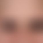 Alopecia areata universalis: Complete, bilateral localized loss of the eyebrows in a 23-year-old ...