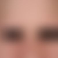 Alopecia areata universalis: Complete, bilateral localized loss of the eyebrows in a 23-year-old ...