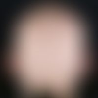 Alopecia areata universalis. Anfangs kreisrunder Haarausfall mit rascher Progredienz, der zur Haa...
