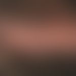 Alopezie, vernarbende. Seit mehreren Jahren persistierende, multiple, glatt atrophische, seitlich...