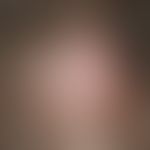 Alopezie, vernarbende. Vernarbende Alopezie bei einer 13-jährigen Patientin mit bekanntem Lupus e...
