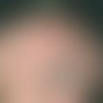 Alopezie, vernarbende. Dynamisch verlaufende, zunehmende entzündliche, vernarbende Haarlosigkeit ...