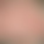 Alopezie, vernarbende. Ausschnitt aus obigem Bild: Patient mit generalisierter Dyskeratosis folli...