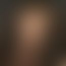Alopecia marginalis. 6 months of persistent, progressive hair loss at the traction points for the...