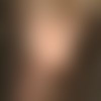 Alopecia marginalis. Detailvergrößerung: Seit 6 Monaten persistierender, progredienter Haarverlus...