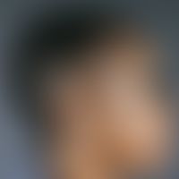 Alopecia marginalis: Haarausdünnung und fokale Haarlosigkeit durch ständigen, Frisur-bedingten Zu...