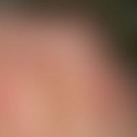 Alopecia neurodermitica. Übersichtsaufnahme: Chronisch stationärer, temporal bis okzipital lokali...