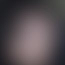 Alopecia parvimaculata. Multiple, fleckig-narbige Alopezieherde bei einem 33-jährigen Mann. Die H...