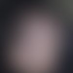 Alopecia parvimaculata. Multiple, fleckig-narbige Alopezieherde bei einem 33-jährigen Mann. Die H...