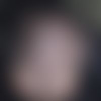 Alopecia parvimaculata. Multiple, fleckig-narbige Alopezieherde bei einem 33-jährigen Mann. Die H...