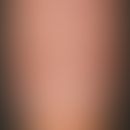 Age nail. longitudinal ripples and longitudinal ridges of the nail plate in inconspicuous periony...