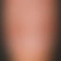 Altersnagel. Längsriffelung und Längsleisten der Nagelplatte bei unauffälligem Perionychium. Die ...
