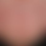 Altersnagel. Altersbedingte Längsrillenbildung bei einem sonst gesunden 65-jährigen Mann. An mehr...