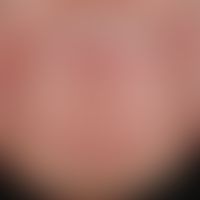 Altersnagel. Altersbedingte Längsrillenbildung bei einem sonst gesunden 65-jährigen Mann. An mehr...
