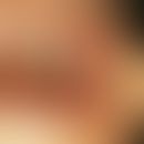 Amalgam-Tätowierung. Rundliche Hyperpigmentierung im Bereich der Wangenschleimhaut neben einer Am...