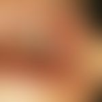 Amalgam tattoo, roundish hyperpigmentation in the area of the cheek mucosa next to an amalgam fil...