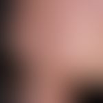 Amiodarone hyperpigmentation: cyanosis-likeamiodarone hyperpigmentation after long-term applicati...