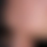 Amiodarone hyperpigmentation: cyanosis-likeamiodarone hyperpigmentation after long-term applicati...