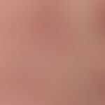 Amiodarone hyperpigmentation. reflected light microscopy: amiodarone hyperpigmentation with inter...