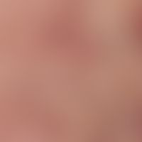Amiodarone hyperpigmentation. reflected light microscopy: amiodarone hyperpigmentation with inter...