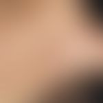 Amyloidosis cutis nodularis atrophicans: Solitary, soft, brownish-yellowish nodule on the nostril...
