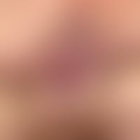 Analfistel. Seit 6 Monaten progrediente, inkomplette Fistel auf 11 Uhr bei einem 36-jährigen Mann.