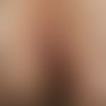 Anal fistula. 1.0 cm in diameter large, reddish-brown, weeping nodules with a smooth surface. no ...
